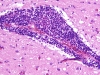 Primary (granulomatous) angiitis of the nervous system